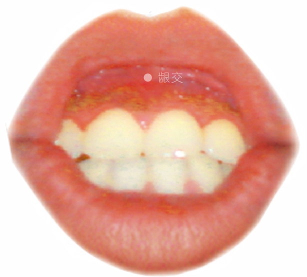 龈交穴​